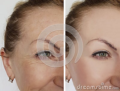Face girl wrinkles before and after correction rejuvenation cosmetic procedures Stock Photo