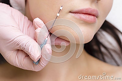 Face lifting PDO Suture operation. innovative technique of New thread lift Stock Photo