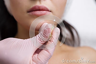 Face lifting PDO Suture operation. innovative technique of New thread lift Stock Photo