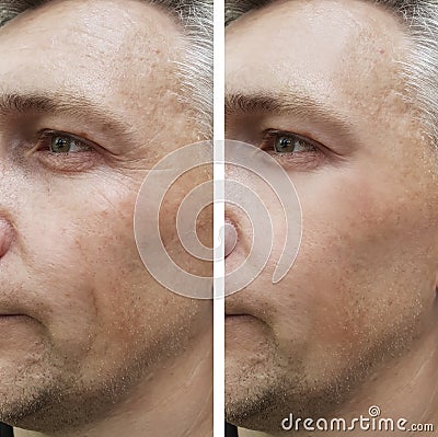 Face man wrinkles before and after Stock Photo