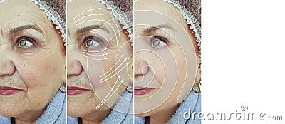 Face old woman wrinkles before after cosmetology arrow plastic correction mature tension rejuvenation treatment Stock Photo