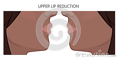 Face side view_Upper lip reduction Afroamerican Vector Illustration