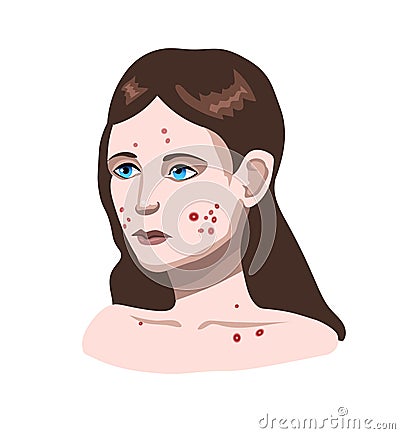 Face with skin problems. Girl with acne Vector Illustration