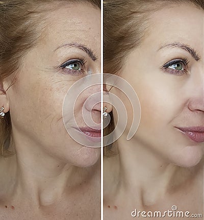 Face woman wrinkles before and after Stock Photo