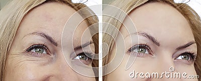 Face woman wrinkles before and after Stock Photo