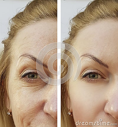 Face woman wrinkles before and after procedure correction Stock Photo