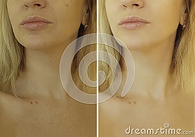 Face woman wrinkles before and after Stock Photo