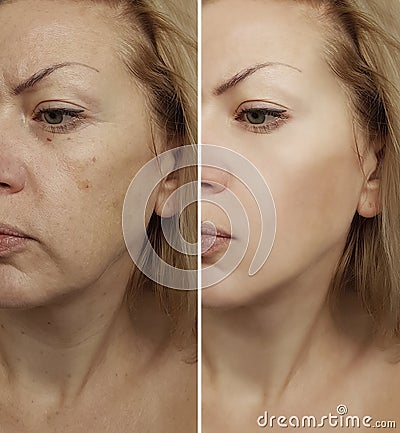 Face woman wrinkles before and after procedure revitalization Stock Photo