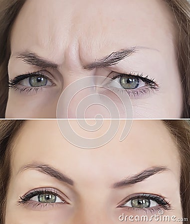 Face wrinkles before and after Stock Photo