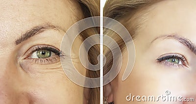 Face wrinkles before and after Stock Photo