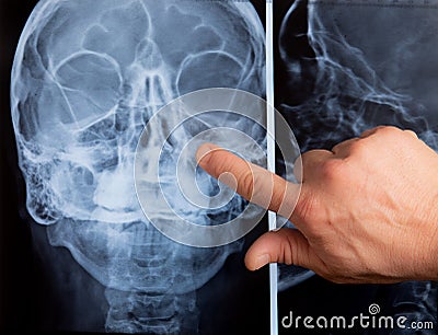 Face xray close up with otorhinolaryngologist hands pointing nose Stock Photo
