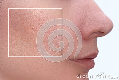 Face of a young woman with an accent on a skin enlarged pores and imperfections treatment, beauty treatment befire and after Stock Photo