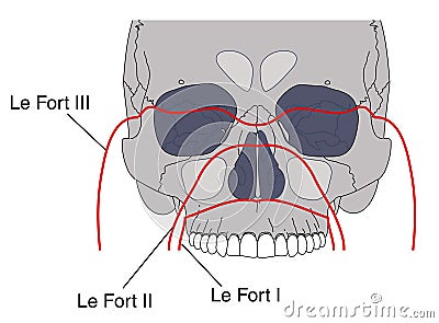 Facial Fractures Royalty Free Stock Image - Image: 12592706