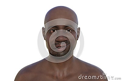 Facial palsy in an African man, 3D illustration highlighting the asymmetry and drooping of the facial muscles on one side of the Cartoon Illustration