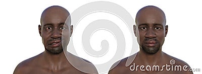 Facial palsy in an African man and the same healthy man, 3D illustration showing the asymmetry and drooping of the facial muscles Cartoon Illustration