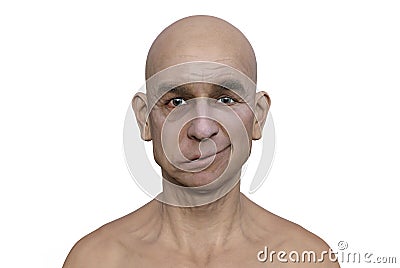 Facial palsy in a man, 3D illustration highlighting the asymmetry and drooping of the facial muscles on one side of the face Cartoon Illustration