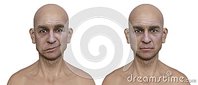 Facial palsy in a man and the same healthy man, 3D illustration showing the asymmetry and drooping of the facial muscles on one Cartoon Illustration
