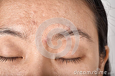 Facial skin problem, Aging problem in adult, wrinkle, acne scar, large pore and dark spot Stock Photo