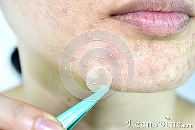 Facial skin problem, Close up woman scar face with whitehead pimples and acne patch. Stock Photo