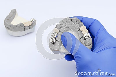 fake teeth. metal and ceramic crowns and bridges. the dentist`s hand holds a plaster model Stock Photo