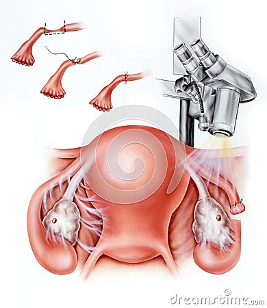 Fallopian Tube Infertility Stock Photo