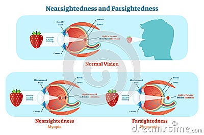 Far Sightedness and Near Sightedness vector illustration diagram, anatomical scheme. Vector Illustration