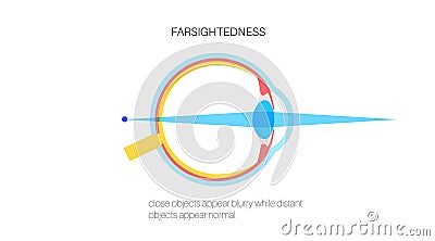 Farsightedness eye disease Vector Illustration