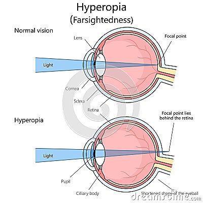 Farsightedness structure diagram medical science Vector Illustration