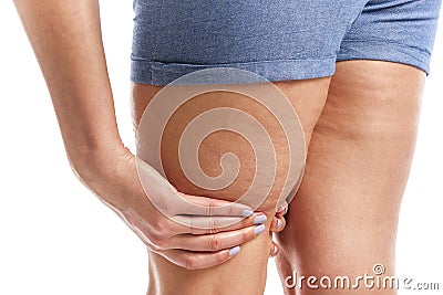 Fat and cellulite on the legs. Stock Photo