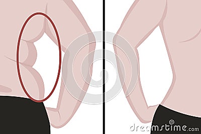 Fat and slim girl`s back. Fat waist. Liposuction. Before and after. Woman body correction Vector Illustration