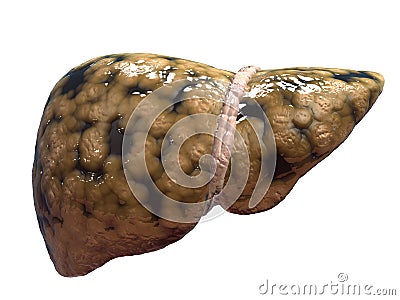 Fatty liver Cartoon Illustration