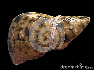 Fatty liver Cartoon Illustration