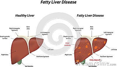 Fatty Liver Disease Vector Illustration