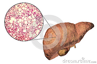 Fatty liver, liver steatosis Cartoon Illustration