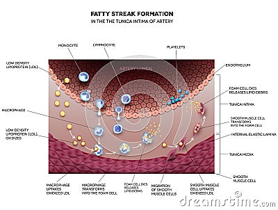 Fatty streak formation in the artery Vector Illustration