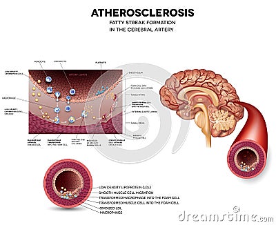 Fatty streak formation in the brain artery Vector Illustration