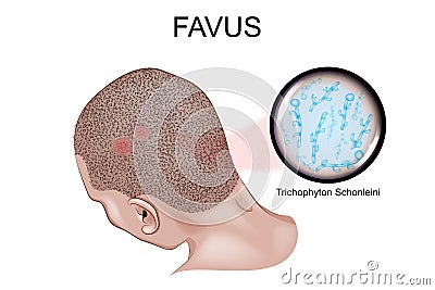 Favus. the causative agent of favus Vector Illustration