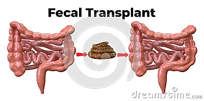 Fecal microbiota transplantation is a procedure in which a donor`s feces are placed in the bowel of the patient with intestinal Stock Photo