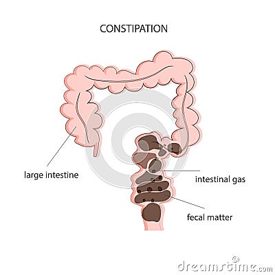 Fecal obstruction and gas accumulation in the intestines Vector Illustration