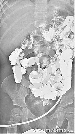 Feeding gtube contrast control xray exam gastrointestine Stock Photo