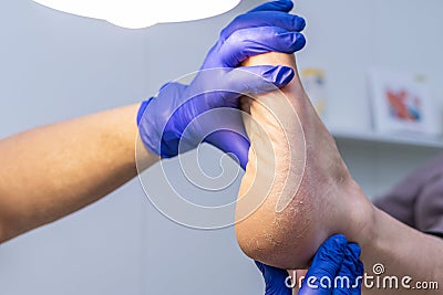 Feet with dry skin, cracked heels, podiatrist examining patient Stock Photo