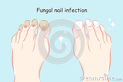 Feet with fungal nail infection Vector Illustration