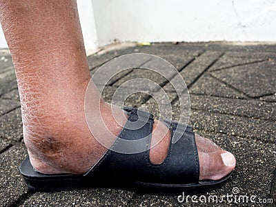 The feet of man with diabetes, dull and swollen. Due to the toxicity of diabetes Stock Photo