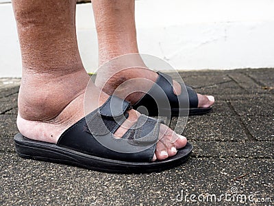 The feet of man with diabetes, dull and swollen. Due to the toxicity of diabetes Stock Photo