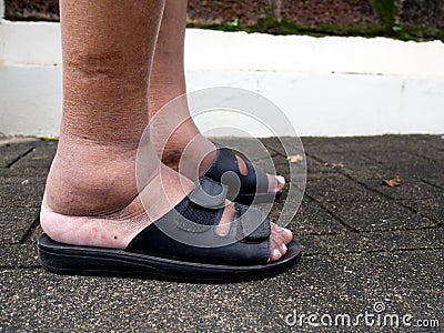 The feet of man with diabetes, dull and swollen. Due to the toxicity of diabetes Stock Photo
