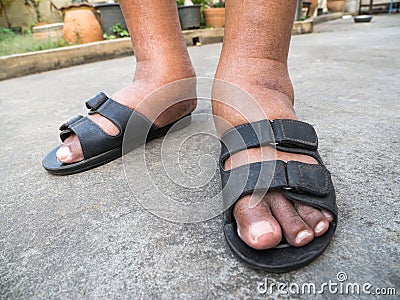 The feet of man with diabetes, dull and swollen. Due to the toxicity of diabetes. Foot swelling caused by drinking water. Stock Photo