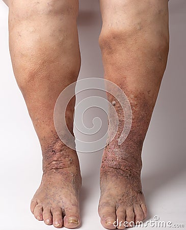 Feet old woman patient with varices on a white background Stock Photo