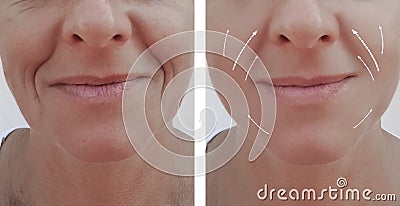 Female adult wrinkles removal dermatology contrast lift filler patient difference before and after procedures, arrow Stock Photo