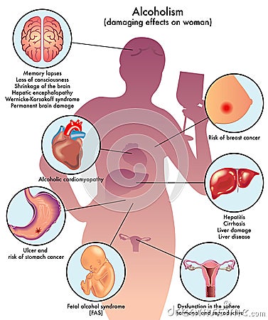 Female alcoholism Vector Illustration