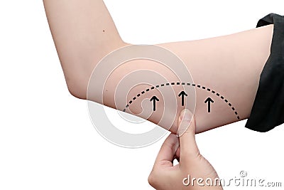 female arm line about to perform liposuction Stock Photo